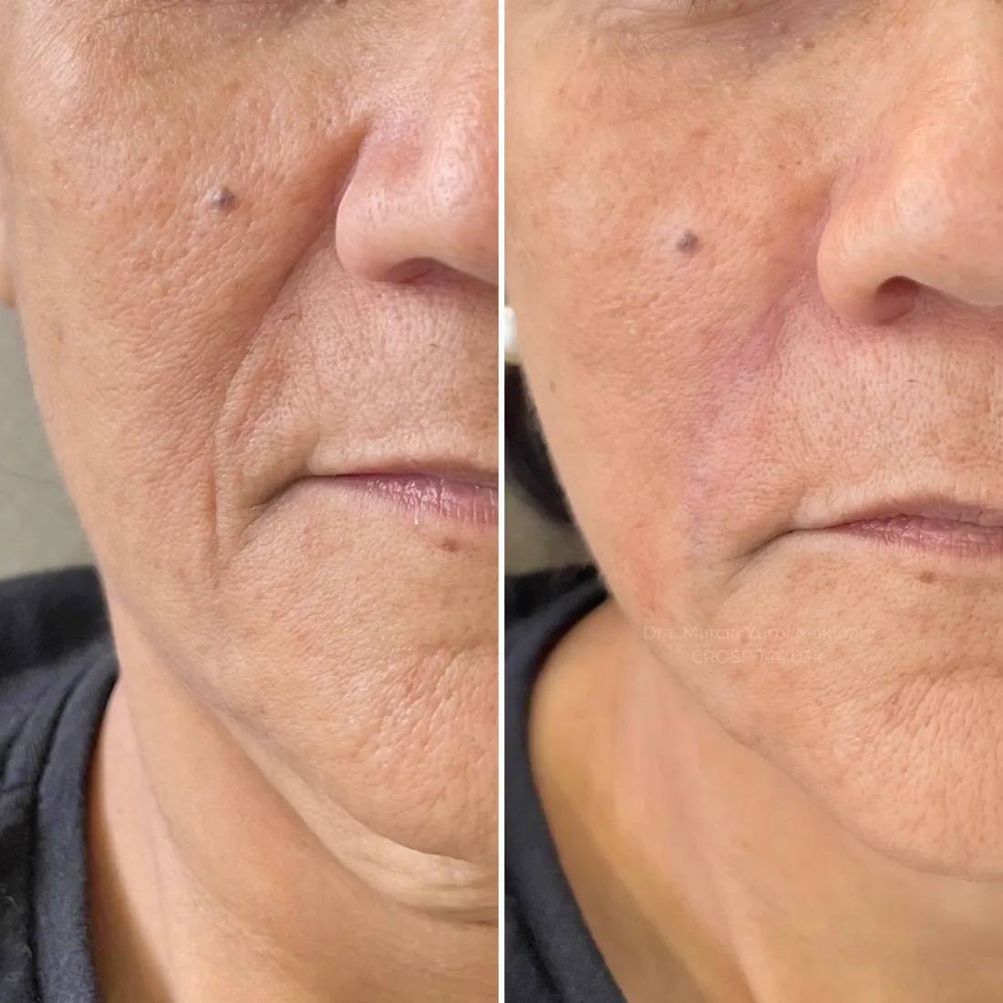 Resultado de preenchimento de bigode chinês (sulco nasogeniano) na HanaClinic, São José dos Campos