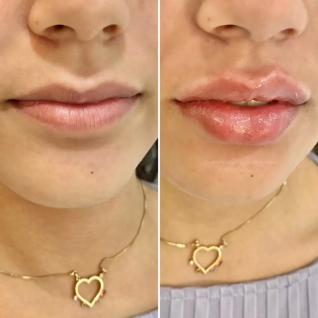 Resultado de preenchimento labial com ácido hialurônico na HanaClinic, São José dos Campos