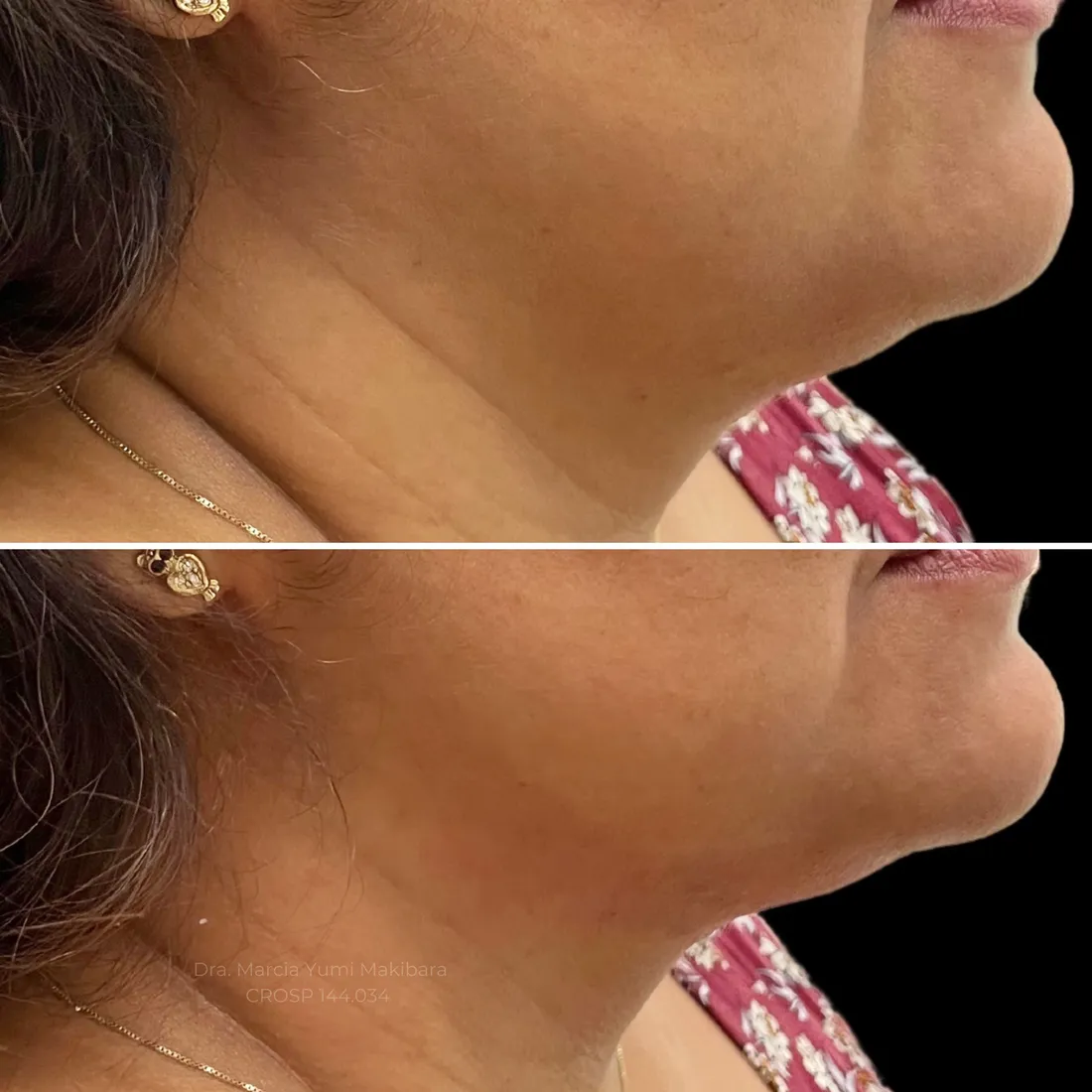 Resultado de Ultraformer III na papada — lifting facial sem cirurgia na HanaClinic, São José dos Campos
